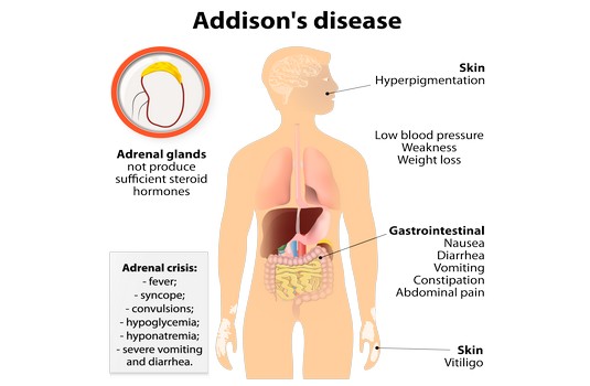 Addisons Disease Treatment In India Cost Hospitals And Doctor 8361